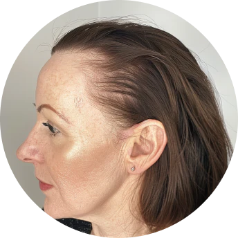 ผมร่วง ผมบาง เส้นเล็ก